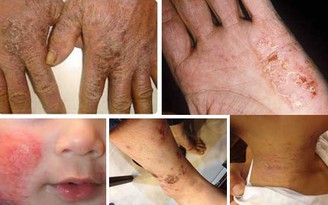 Đừng để bệnh chàm (eczema) ảnh hưởng đến cuộc sống!