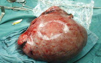 Mổ lấy khối u xơ trong tử cung nặng 3,2 kg