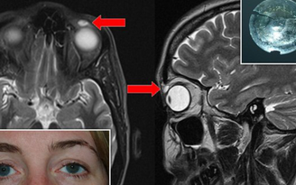 Bác sĩ cũng sốc: Kính sát tròng bị bể dính chặt vào mi mắt 28 năm