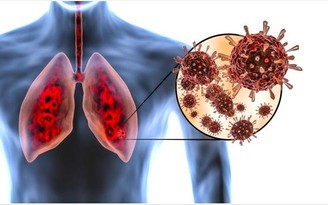 Tại sao người từng nhiễm Covid-19 cần chú ý nhiều hơn đến phổi?