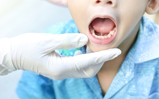 Phẫu thuật dính thắng lưỡi cho trẻ em có về trong ngày được không? Phẫu thuật dính thắng lưỡi cho trẻ em có về trong ngày được không?