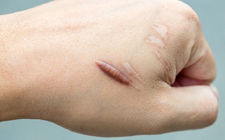 Tại sao lại có sẹo và cách điều trị hiệu quả?