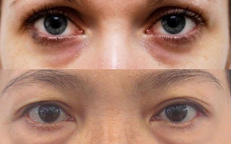 Phân biệt thầm quâng và bọng mắt giúp bạn tìm ra cách điều trị tốt nhất