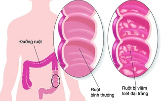 Hỗ trợ điều trị viêm đại tràng nhờ công nghệ bào tử lợi khuẩn