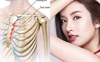 Sự thật về phương pháp nâng mũi sụn sườn Fascia