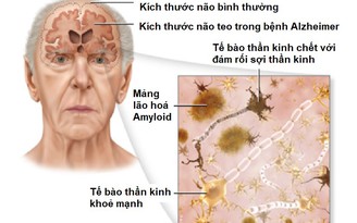 Hãy nhận biết sớm để điều trị hiệu quả bệnh mất trí nhớ Alzheimer