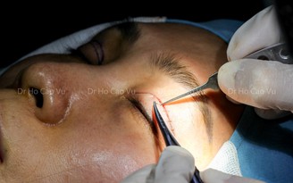 ThS-BS Hồ Cao Vũ cho biết các biến chứng trong phẫu thuật cắt mí mắt