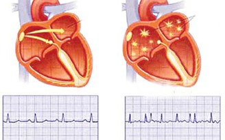 Cụ ông 'lười' uống thuốc điều trị rung nhĩ, phải phẫu thuật