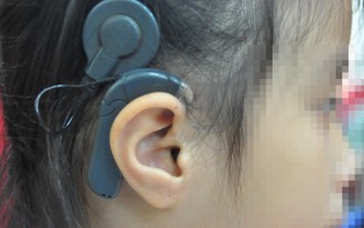 Đeo tai nghe quá nhiều khiến người trẻ bị giảm thính lực