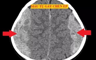 Bé trai 4 tuổi té giường tầng bị chấn thương sọ não nặng