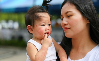 Dị ứng ở trẻ - Hoàn toàn có thể phòng tránh được