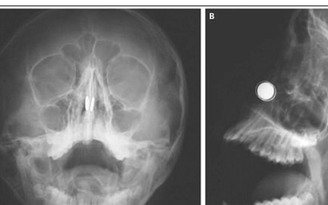 Cậu bé chơi dại bỏ hai cục nam châm vào lỗ mũi, may mà bác sĩ cứu kịp