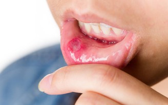 8 lưu ý khi chữa loét miệng không cần dùng thuốc