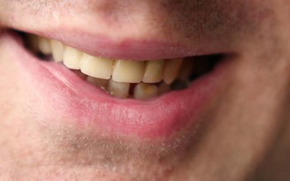 Vàng răng và những cách loại bỏ vàng răng