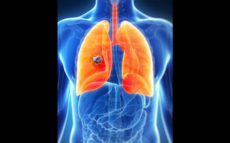 Liệu pháp miễn dịch giúp bệnh nhân ung thư phổi sống lâu hơn