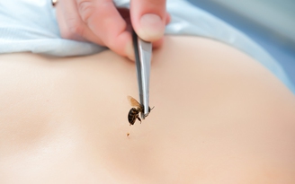 4 bệnh nhân đi cấp cứu vì bị ong chích