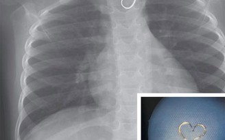 Phát hiện 'trái tim' trên hình X-quang của bé gái 3 tuổi
