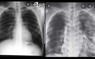 Hình ảnh chụp CT cho thấy gì trong phổi người nhiễm COVID-19?
