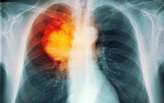 3 dấu hiệu sớm của ung thư phổi rất nhiều người bỏ sót
