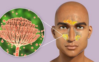 Viêm xoang do nấm có gây ra đau đầu? Viêm xoang do nấm có gây ra đau đầu?