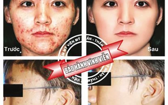 Điều trị mụn - thâm đột phá với công nghệ Nano hàng đầu của Mỹ