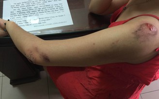 Nữ nạn nhân bị cướp kéo lê trên đường: 'Tôi té bật ngửa rồi bị lôi đi'