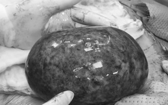 Đồng Nai: Phẫu thuật lấy khối u buồng trứng nặng gần 1 kg