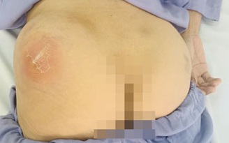 Tự tiêm thuốc vào mông, một phụ nữ bị áp xe phải nhập viện