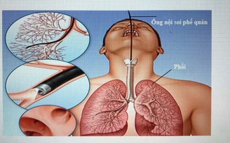 Bệnh nhân tử vong sau khi nội soi phế quản ở Bệnh viện Bạch Mai