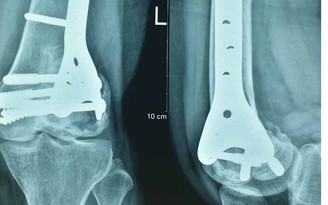 Ghép xương đồng loại giúp bệnh nhân bị tiêu hủy xương tiết kiệm 90% chi phí