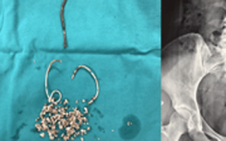 Phẫu thuật lấy stent gãy rời sau 5 năm nằm trong niệu quản bệnh nhân