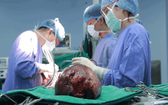 Bệnh nhân mang khối u gan khổng lồ đường kính 30 cm