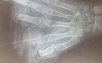 Thiếu niên 14 tuổi dập nát bàn tay do pin quạt tích điện phát nổ
