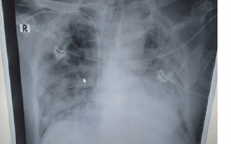 Thêm 3 bệnh nhân viêm phổi suy hô hấp do nhiễm Covid-19 tử vong