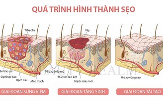 Nguyên nhân gây sẹo lồi và cách trị sẹo lồi hiệu quả hiện nay