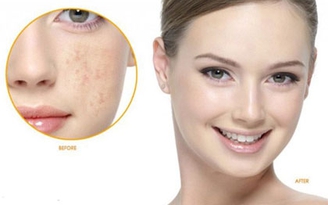 3 điều cần thực hiện nếu muốn trị nám da tận gốc