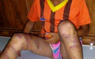 Bé gái 8 tuổi bị cha đẻ đánh dã man