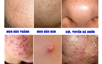 Mụn dai dẳng - Chuyên gia khuyên gì?