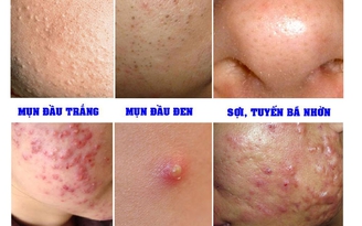 Mụn dai dẳng – Chuyên gia khuyên gì?
