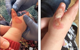 Máy hút bụi khiến bé trai 16 tháng bị bỏng do kẹt tay