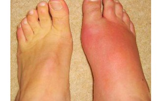 Thuốc tiêm - 'vũ khí' mới chống lại bệnh gout?