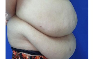 Những nguy cơ tai biến do phẫu thuật giảm béo