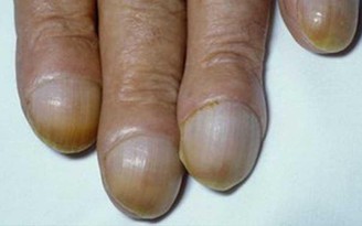 Gần 40% bệnh nhân ung thư phổi gặp dấu hiệu này ở đầu ngón tay