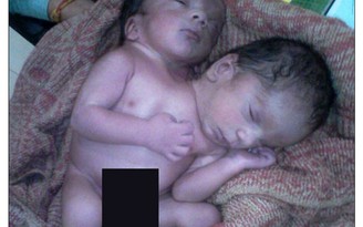 Cặp song sinh dính liền có 2 đầu ở Ấn Độ