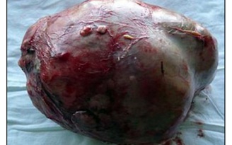 Cắt bỏ khối u to bằng quả bóng rổ trong bụng