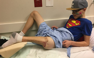 Bị cắt cụt chân vì ung thư, cậu bé được tạo khớp gối mới