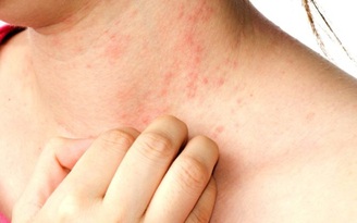 Người bị bệnh ngoài da cũng đối mặt với nguy cơ mắc nhiều bệnh khác