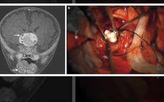 Khối u kỳ lạ mọc răng trong não cậu bé