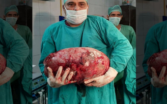 Cô gái 16 tuổi có khối u buồng trứng to bằng trái dưa hấu 15 kg
