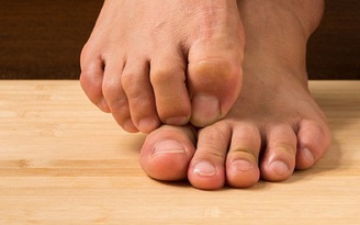 Phải làm gì khi bị nấm móng chân?